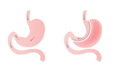 cirurgia-bariatrica2