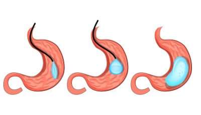 cirurgia-bariatrica3