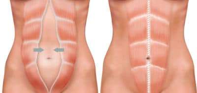 o que é diástase abdominal